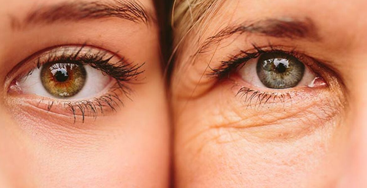 A szem körüli bőr öregedésének külső jelei két különböző korú nőnél
