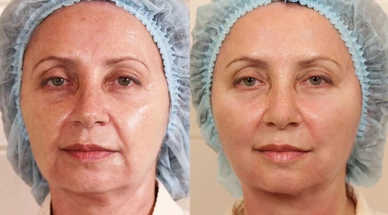 arcplasztika előtti és utáni fotók